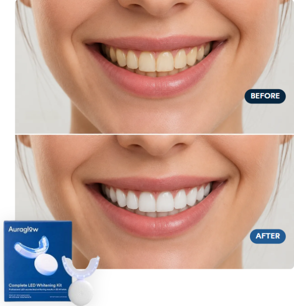 Auraglow Teeth Whitening Kit result
